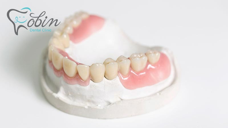 قالب گیری برای پروتز دندان قبل از انجام پروتز انجام می شود.
